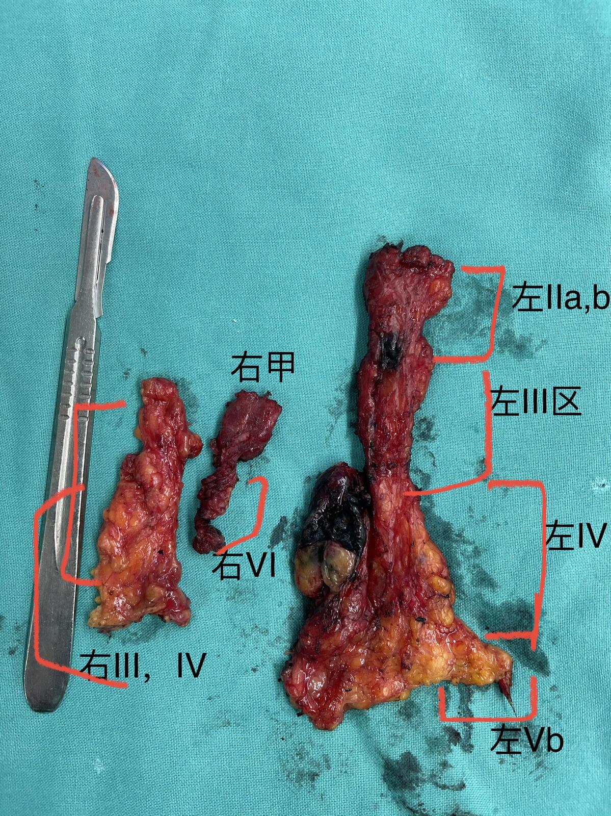 甲狀腺髓樣癌容易淋巴結轉移 - 好大夫在線