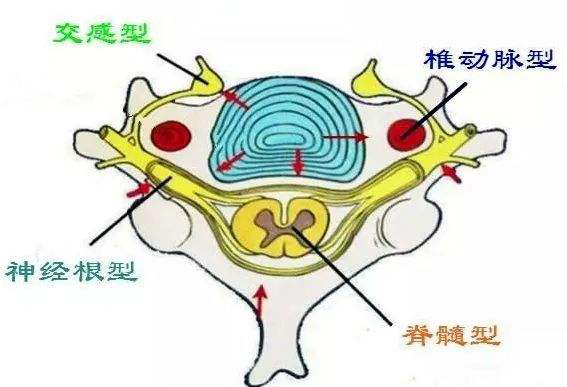 颈椎病分型 png