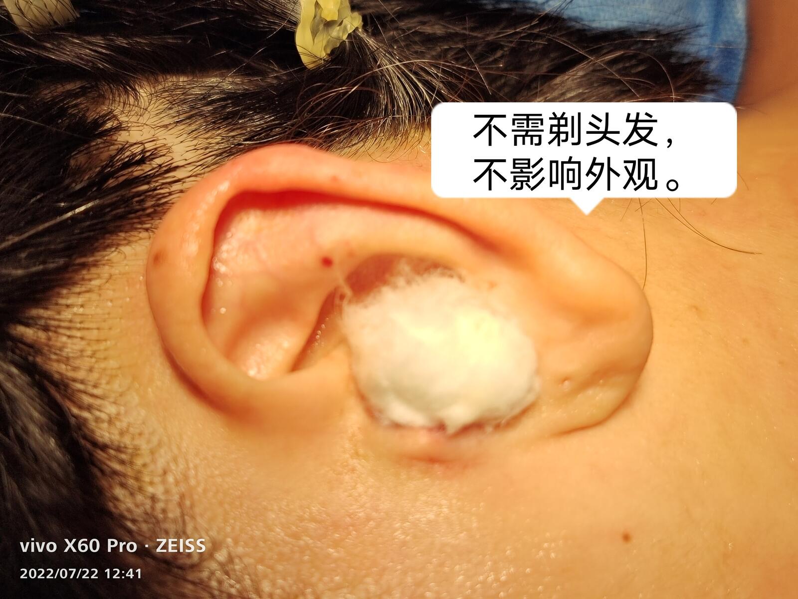 耳膜穿孔不流脓需不需要手术