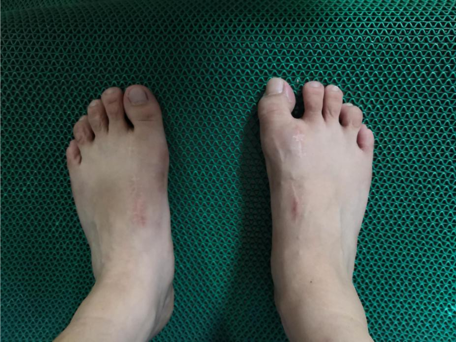 拇外翻术后并发症-----拇内翻治疗_拇外翻_拇外翻治疗方式 - 好大夫