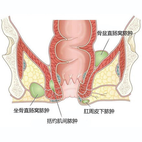 肛周脓肿冠面图 拷贝.jpg