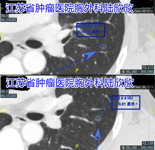 左上小蜂窝磨玻璃结节放大四张图CT值水印.jpg