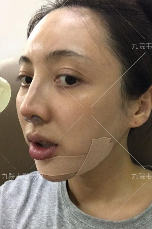 舒铂隆颏给我失败的下巴第二次美丽_隆下颏_隆下颏治疗介绍 - 好大夫