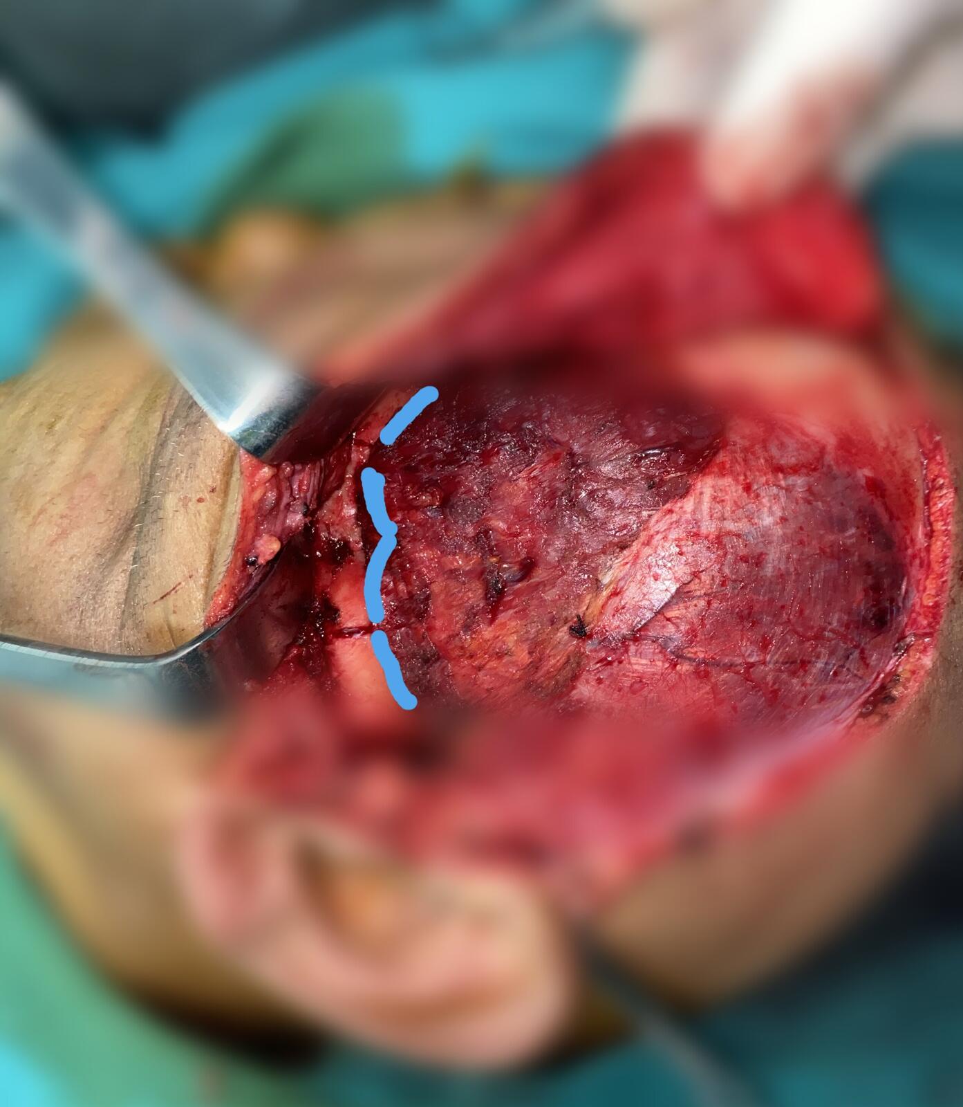 颧骨颧弓骨折的精准切开解剖复位,可吸收板坚固内固定手术
