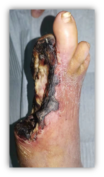 右髂动脉支架置入 右股动脉支架内球扩成形置管溶栓术右股,腘动脉球扩