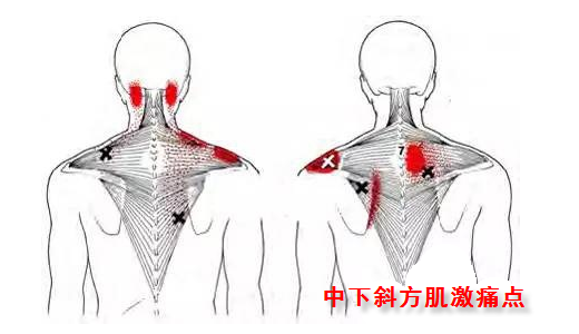 中斜方肌纤维通常不产生激痛点,但如果有疼痛点存在,在肩胛骨内缘靠近