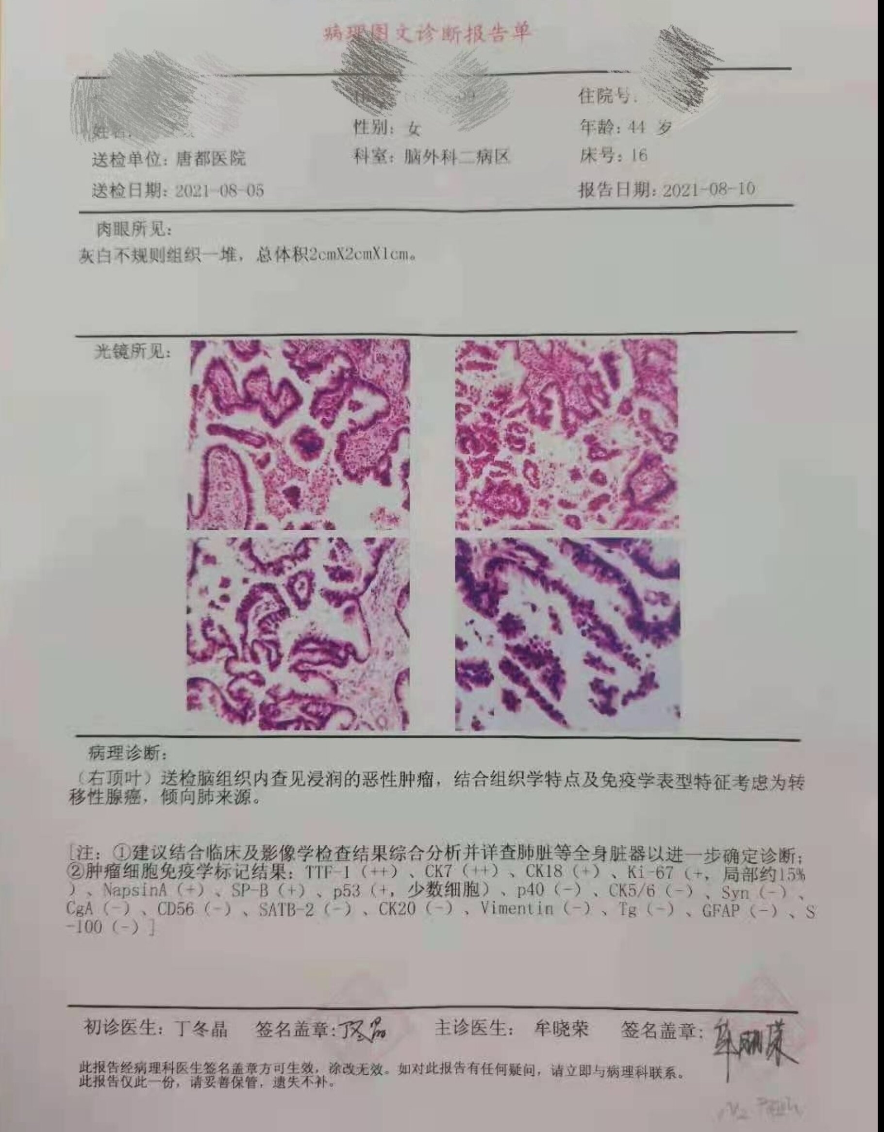 早期肺癌病理报告图片图片