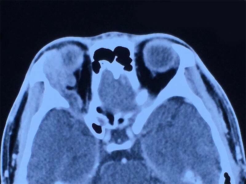 泪腺肿瘤图片图片
