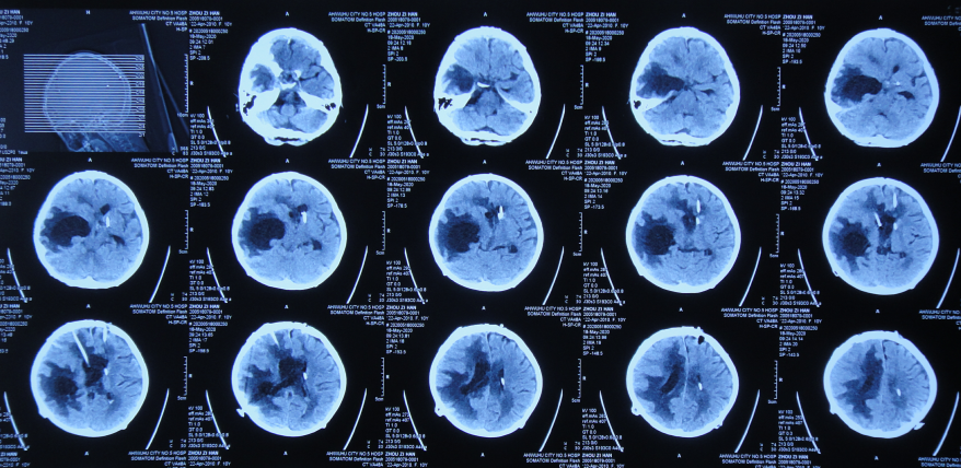 顱內生殖細胞瘤切除術後腦積水仍反覆半年內4家醫院治後顱內感染加重