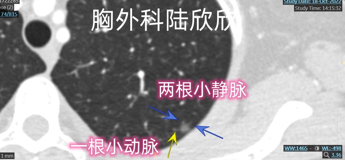 左上1薄层74放大3根小血管水印.jpg