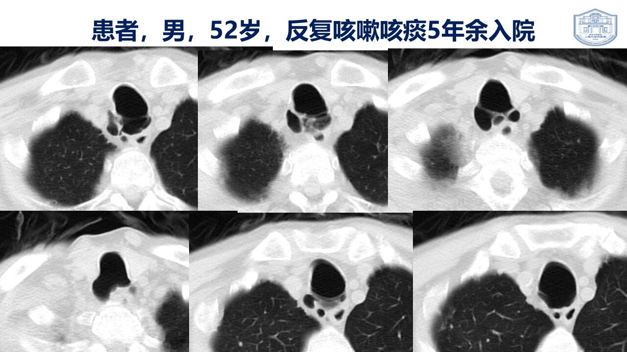 气管憩室是什么疾病?需不需要治疗?