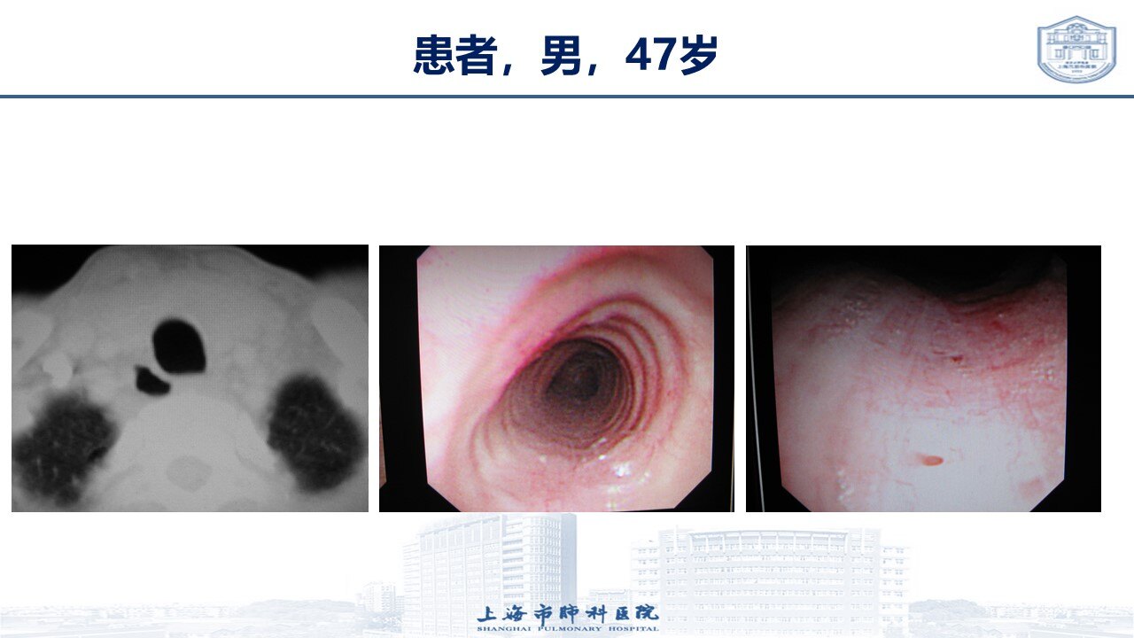 气管憩室是什么疾病?需不需要治疗?