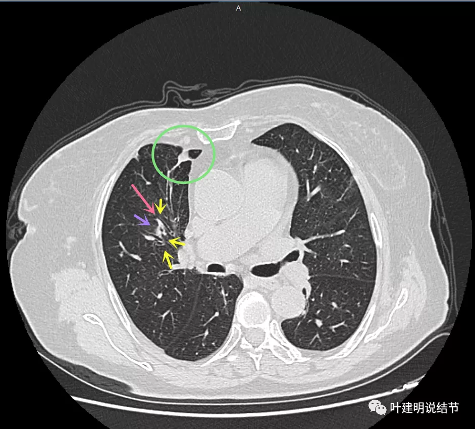 问诊分析:这样的右上肺实性结节像不像恶性? 