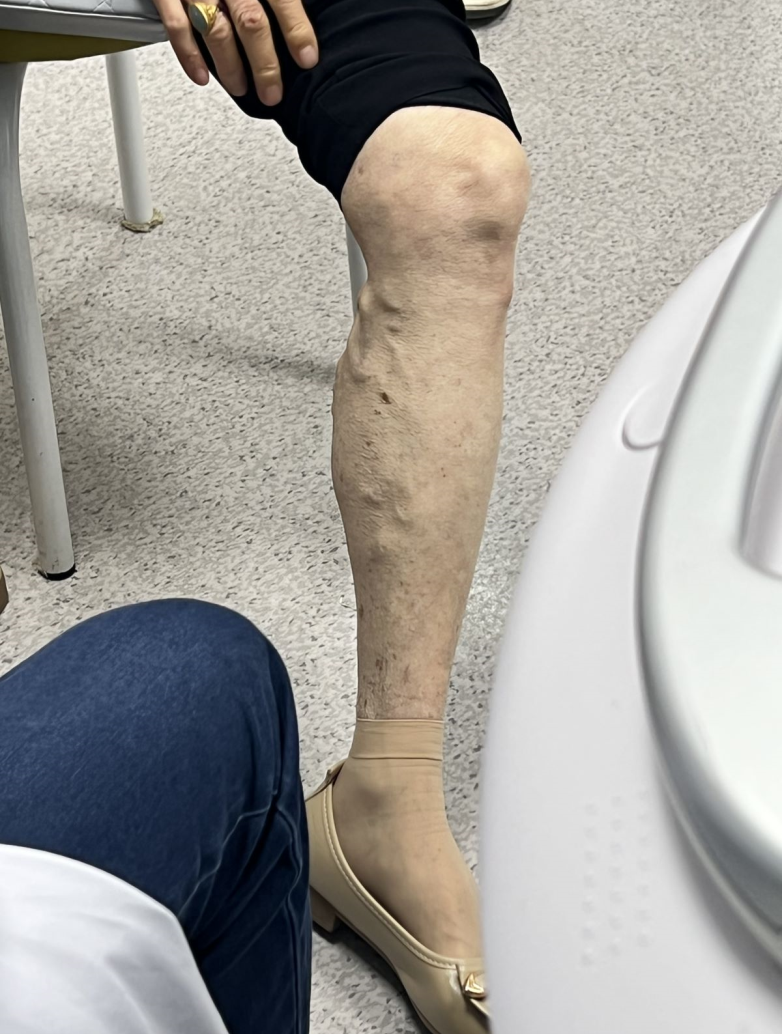 「炸筋腿案例1」76岁阿婆手术时是聊聊天,你的手术只会叫苦连天?
