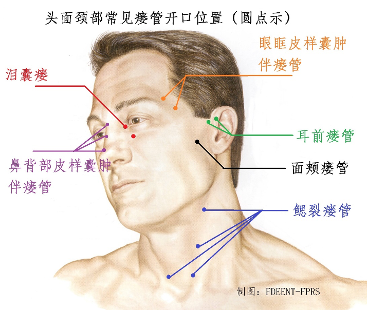 耳前瘘管遗传图谱图片