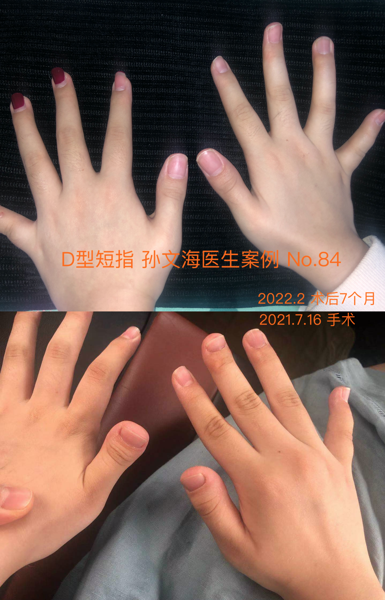 D型短指症的手术方法 附案例集 短指症 好大夫在线 D型短指症的手术方法 附案例集 短指症 好大夫在线