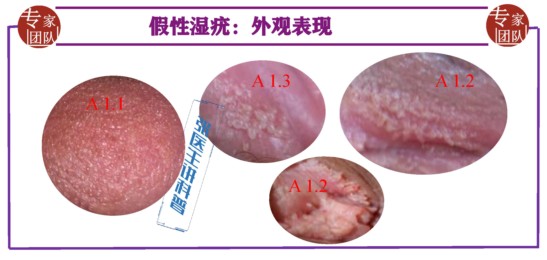 私处颗粒状丘疹或绒毛状突起,需考虑「假性湿疣」