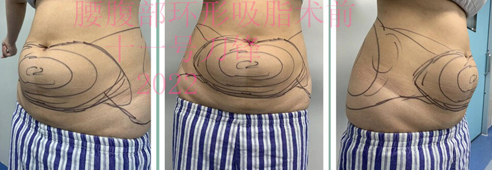 腰腹环吸案例图片
