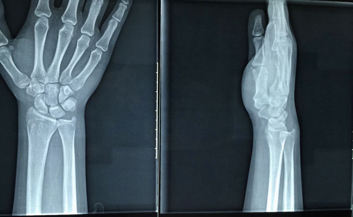 闭合复位克氏针固定临床病例二旋前型损伤:腕尺桡关节分离tfc撕裂旋前