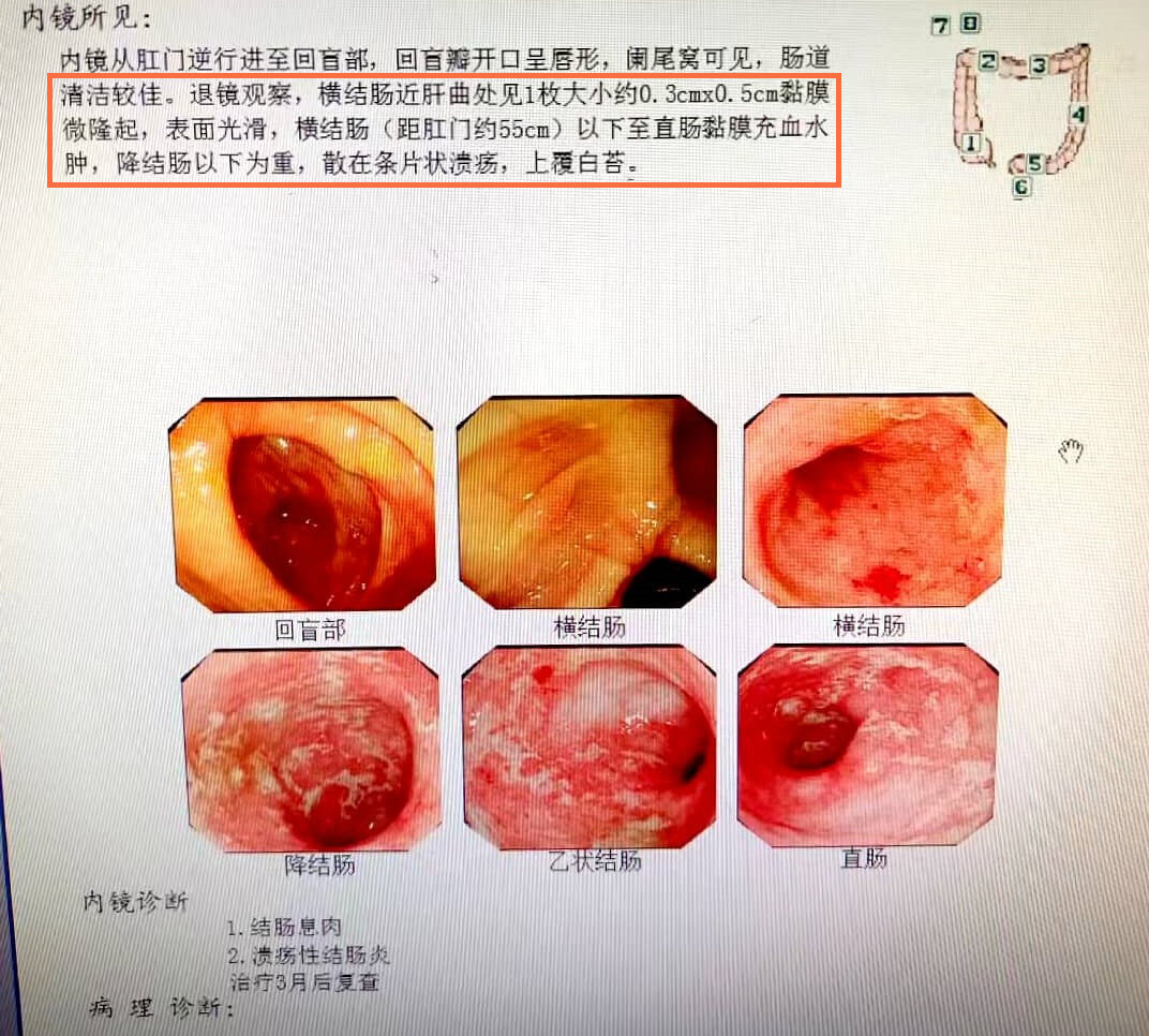 青玉散使中重度广泛结肠型溃疡性结肠炎患者重拾信心