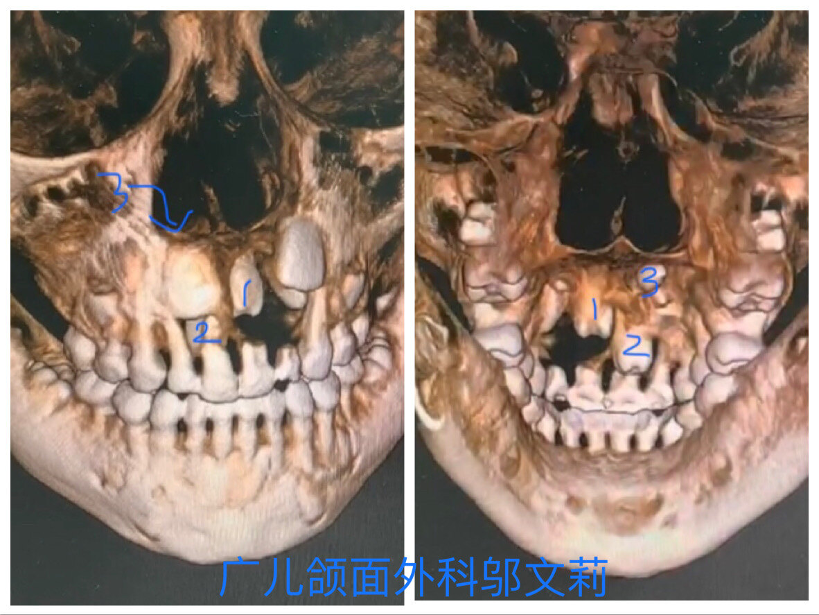 日間手術多生牙埋伏牙的外科正畸聯合治療