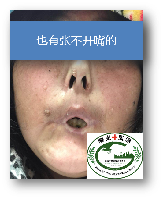 BS口腔溃疡一般不留疤痕.png