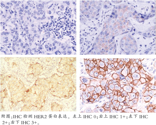 乳腺癌her2的標準化檢測