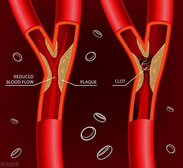 颈动脉狭窄诊治攻略(1)