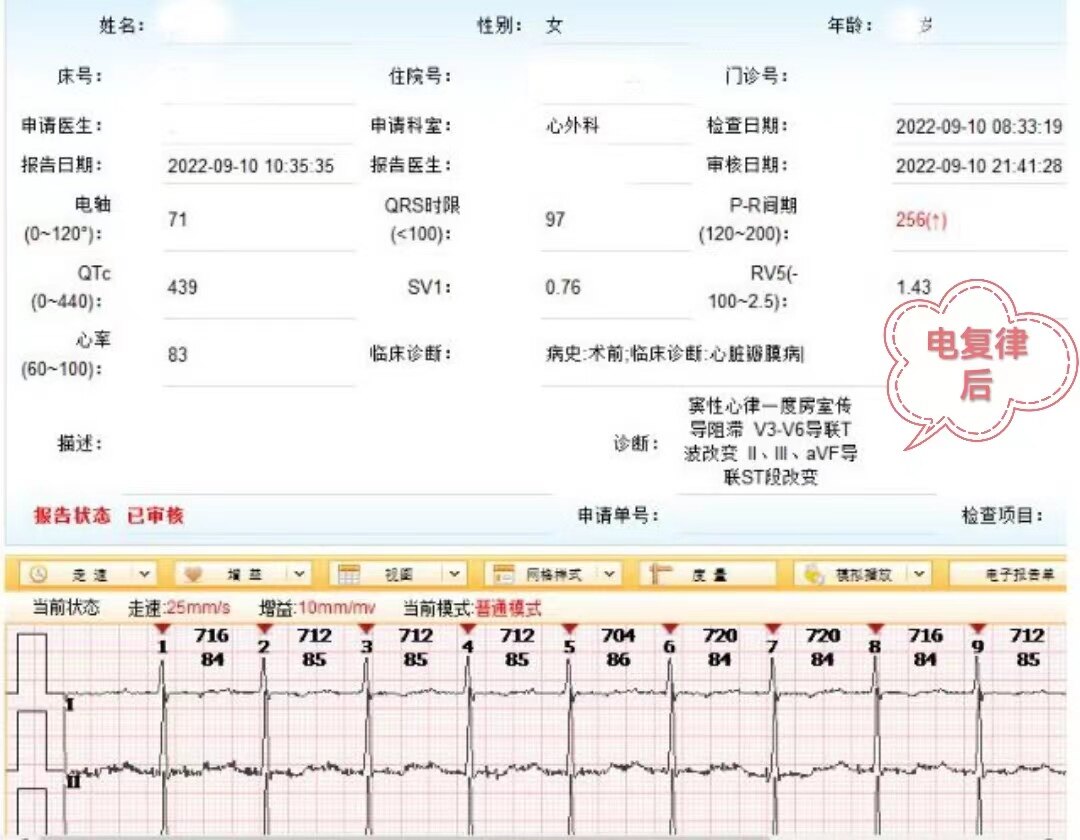 复律后心电图.jpg