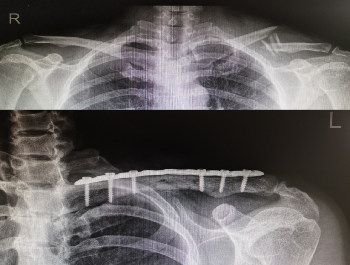 锁骨骨折术后 你需要注意的事 锁骨骨折 好大夫在线 锁骨骨折术后 你需要注意的事 锁骨骨折 好大夫在线