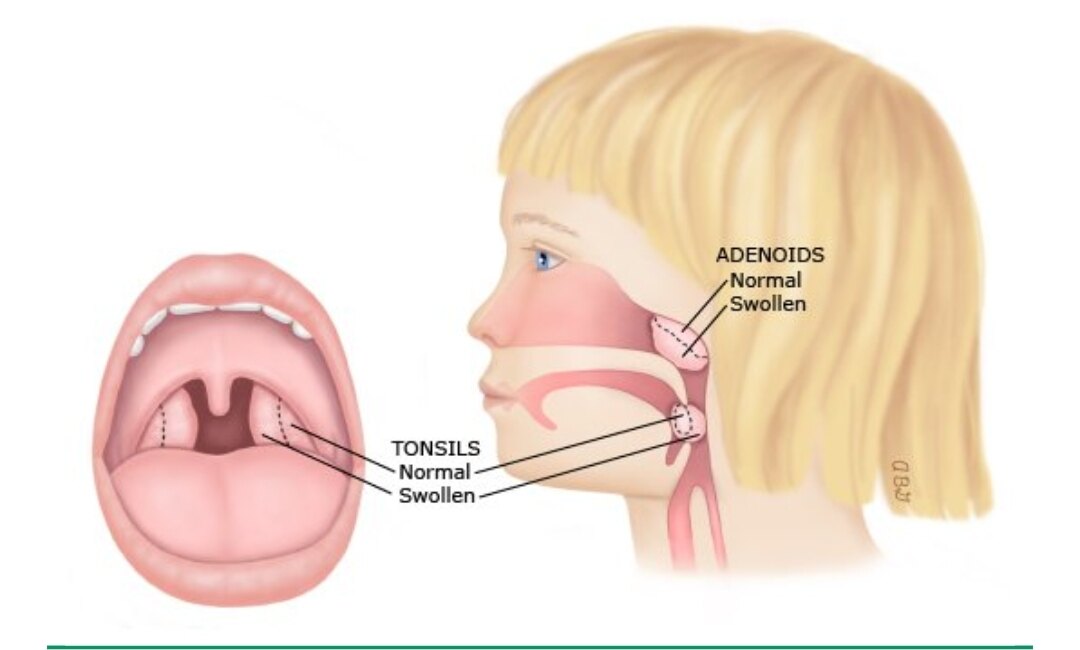 儿童睡眠呼吸暂停