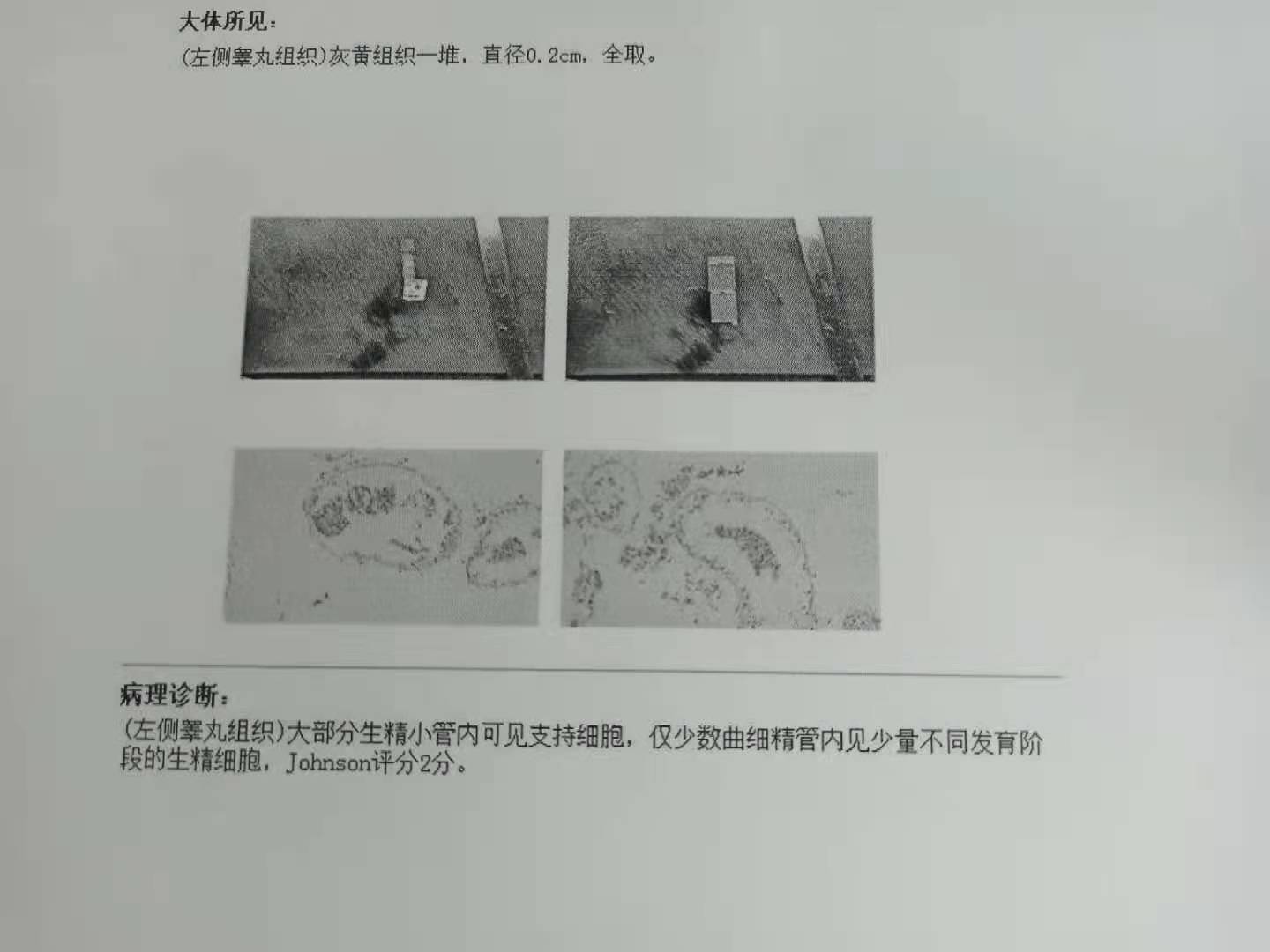 未见生精细胞1,唯支持细胞综合征无精症如果从睾丸活检或穿刺病理角度