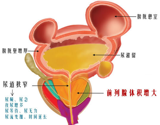前列腺的分区示意图图片