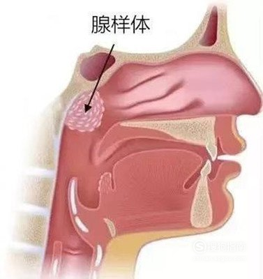 小儿腺样体肥大