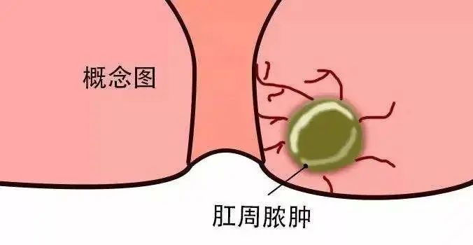 肛周脓肿