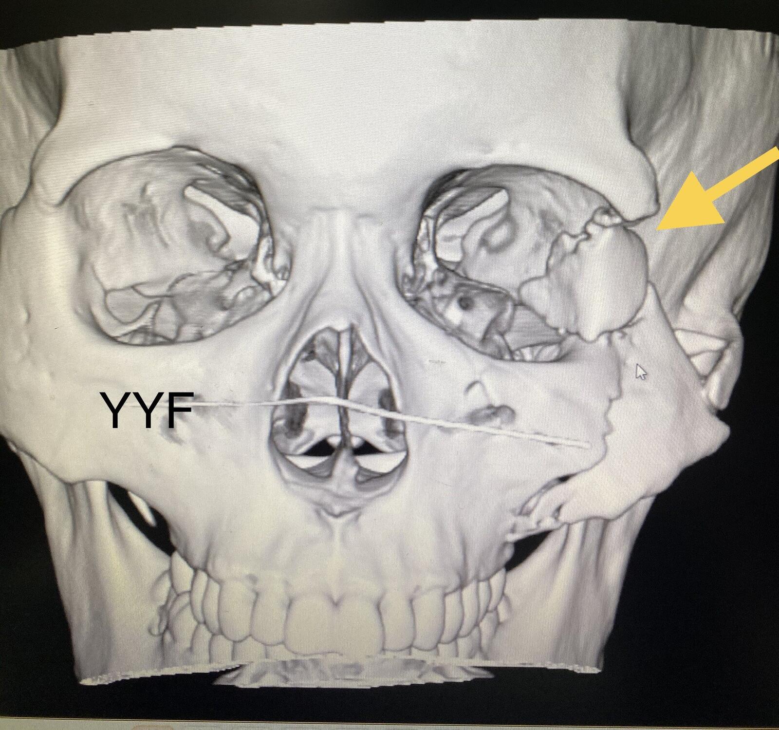 眼眶複合性骨折之外側壁及顴骨骨折的手術治療時機及方法 - 好大夫