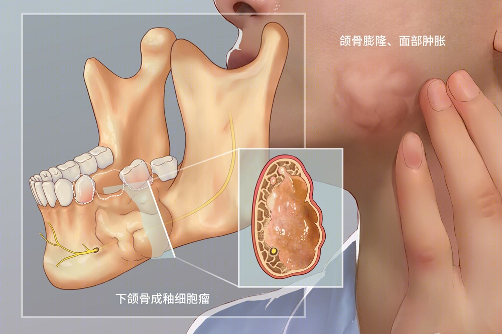 长骨造釉细胞瘤图片