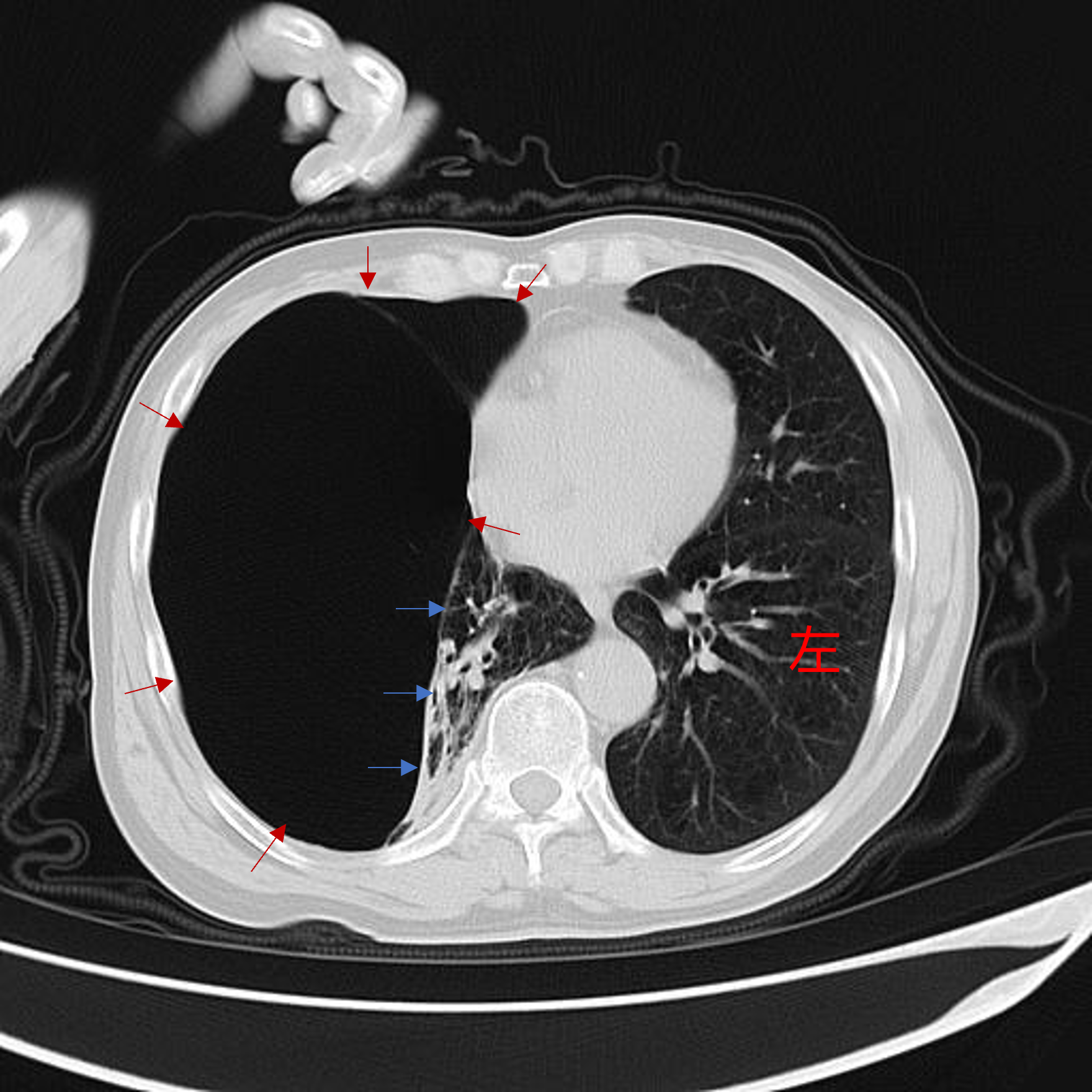 肺大泡的x线典型图片图片