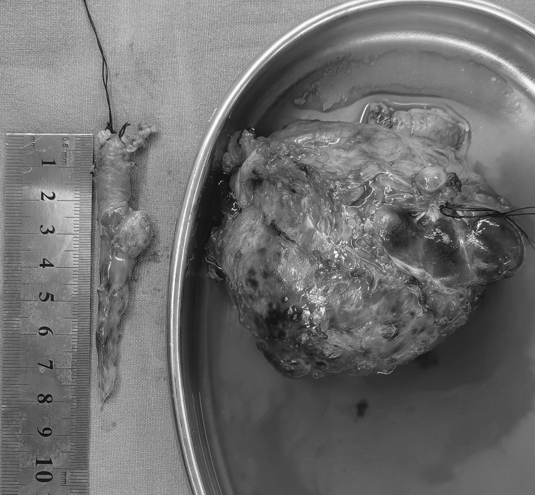 肾母细胞瘤 www.haodf.com