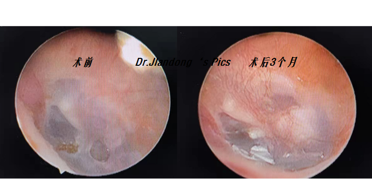 耳内窥镜手术.png