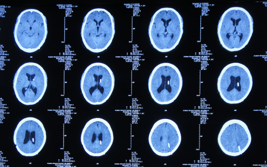 图-15:2015年11月6日头颅ct终于脑脊液各项化验达标后于2015年12月7日