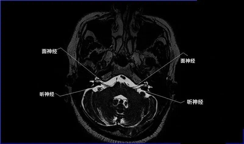 神外科普 l 听神经瘤_听神经瘤_介绍_症状表现_检查_治疗方式_日常注意事项 - 好大夫在线