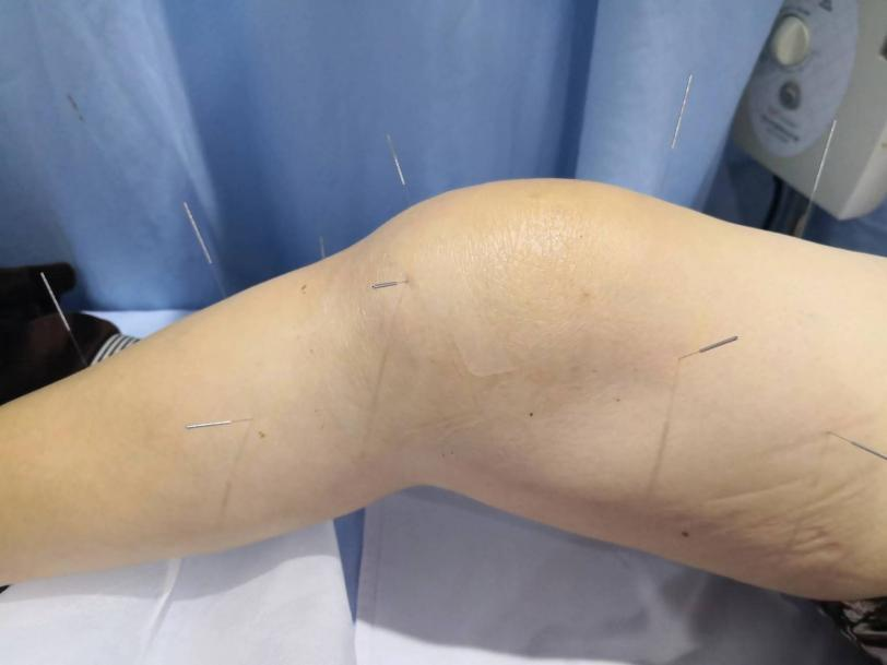 膝关节针灸位置图片图片