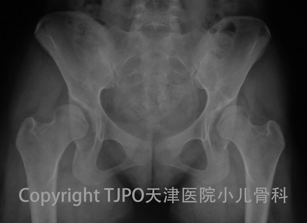 tjpo兒童髖關節發育不良科普6大齡兒童髖關節發育不良手術治療骨盆