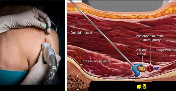 腋神经超声图谱及引导阻滞 - 好大夫在线