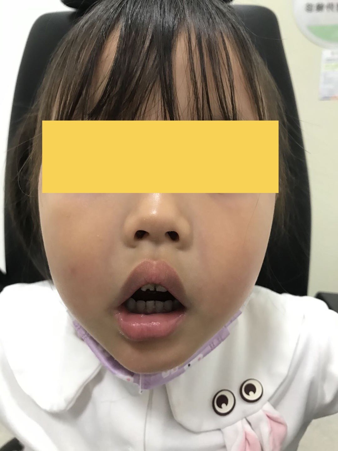 儿童鼻窦炎的图片大全图片