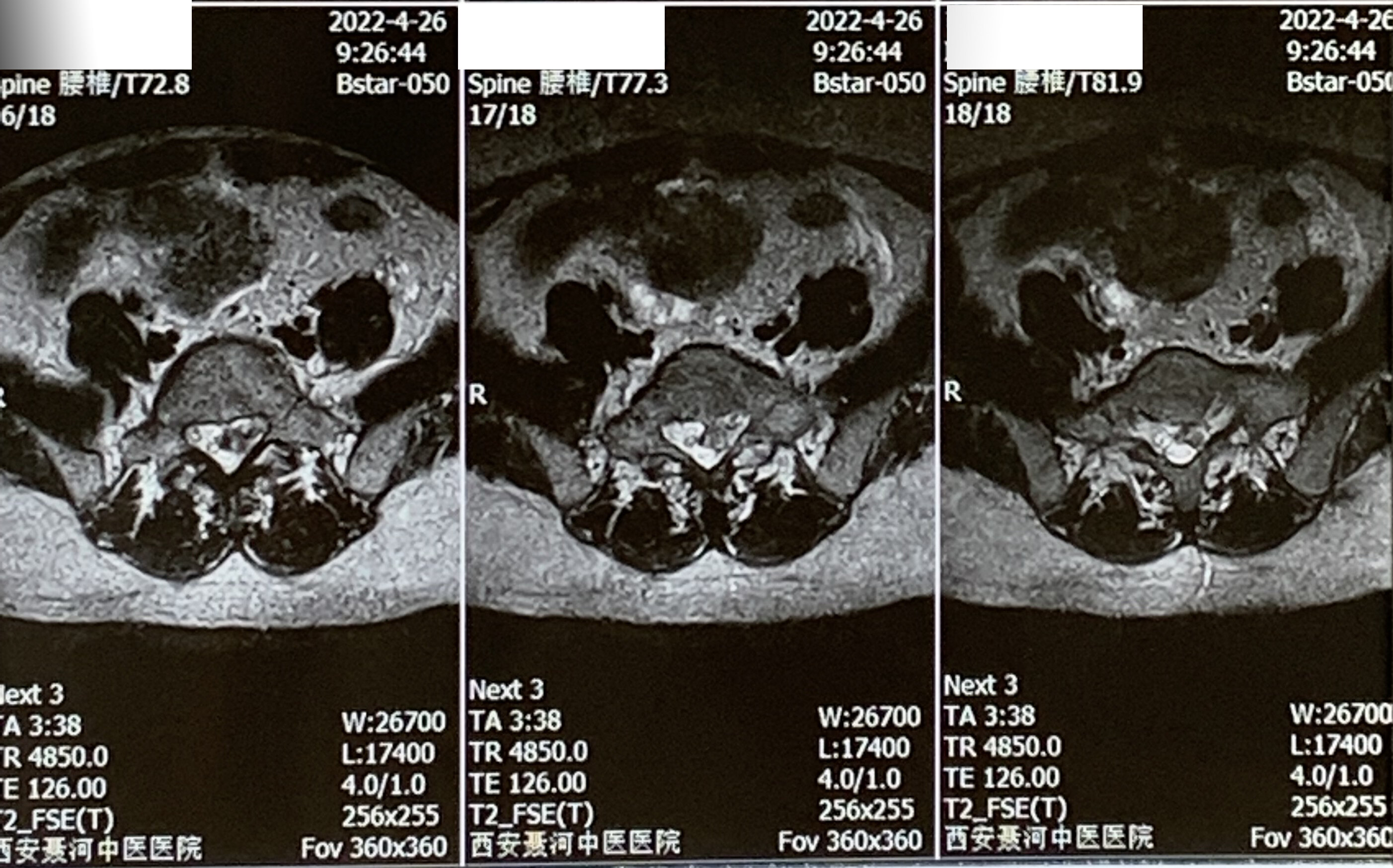 20220426西安長安聶河中醫院腰椎磁共振04.jpg