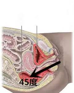 陰道塞藥的正確方法