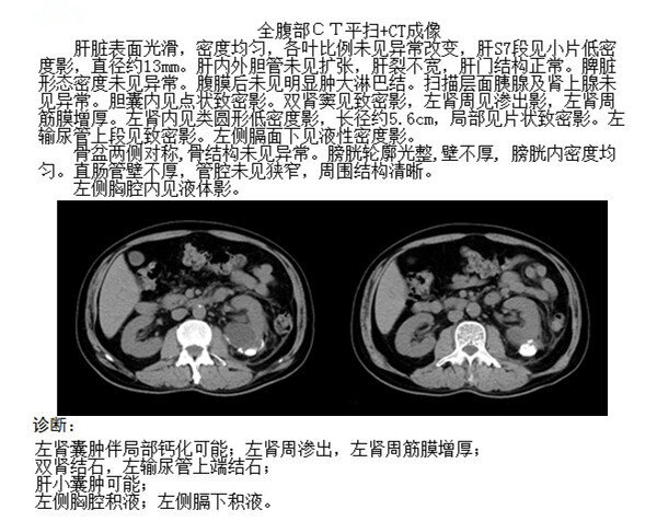 复杂性肾囊肿图片