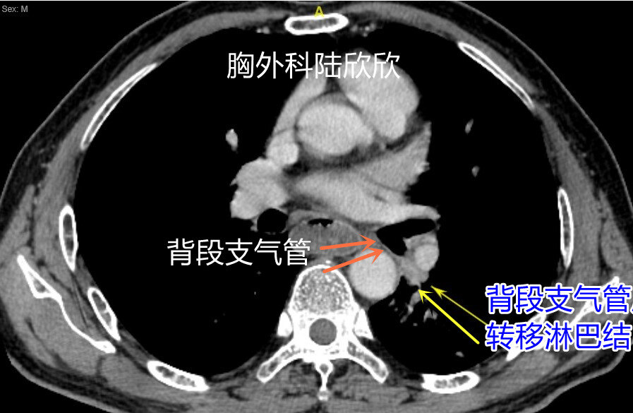 转移淋巴结CT水印.jpg